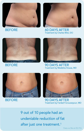 CoolSculpting® El Paso, TX