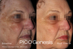 PICO Genesis™ Skin Rejuvenation El Paso, TX