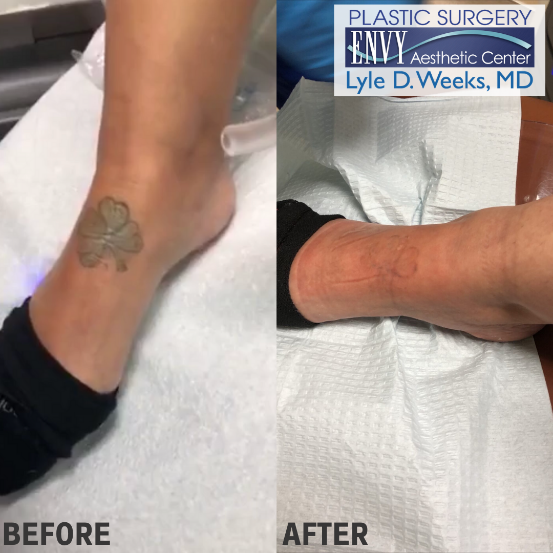 Before and After results from laser tattoo removal on a patient's foot