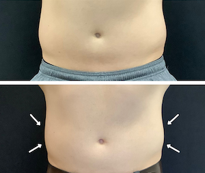 Female patient's midsection before and after the EMSCULPT® treatment