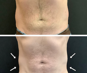 Male patient's midsection before and after the EMSCULPT® treatment