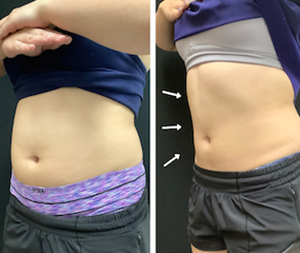 Female patient's midsection before and after the EMSCULPT® treatment