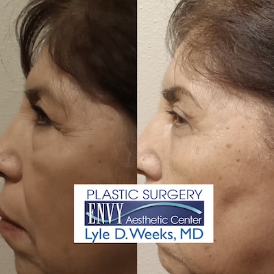 Eyelid Lift - Envy Aesthetic Center, El Paso, TX Eyelid Lift - Envy Aesthetic Center, El Paso, TX