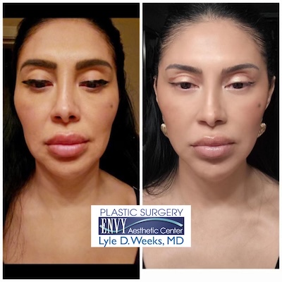 Before and After Facelift - Envy Aesthetic Center, El Paso, TX Before and After Facelift - Envy Aesthetic Center, El Paso, TX