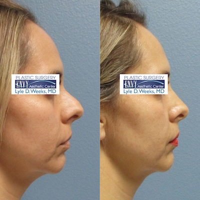 Before and After Revision Rhinoplasty - Envy Aesthetic Center, El Paso, TX Before and After Revision Rhinoplasty - Envy Aesthetic Center, El Paso, TX
