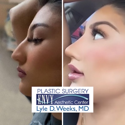 Rhinoplasty - El Paso, TX Rhinoplasty - El Paso, TX